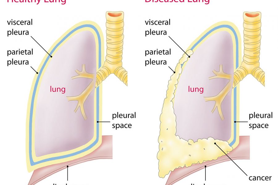Malignant Pleural Mesothelioma