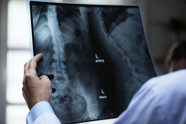 Stage 2 Mesothelioma Facts